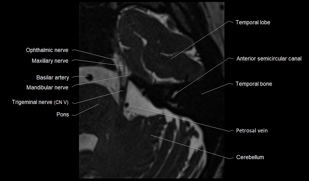 Internal auditory canal (IAC) axial cross sectional anatomy image 28.webp